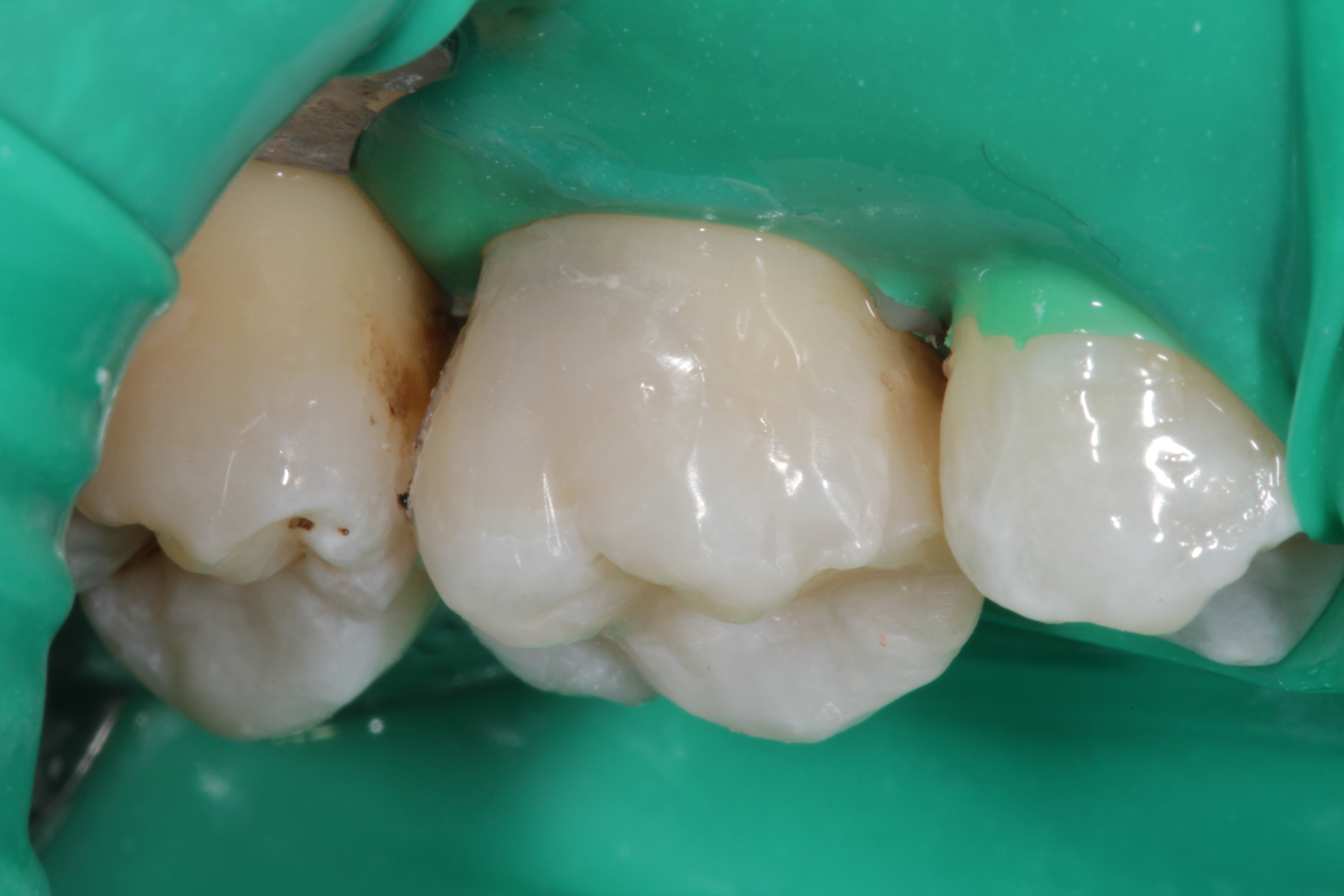 Prothèses dentaires
